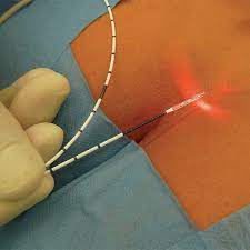 tratamento a laser de cisto pilonidal
